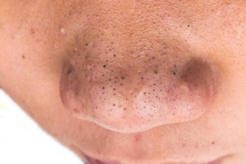 Черные точки воском удаление: можно ли воском убрать черные точки